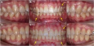 Mucogingival Surgery
