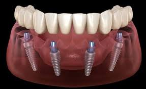 Implant Supported Dentures