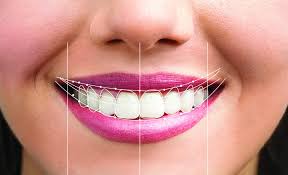 Smile Design